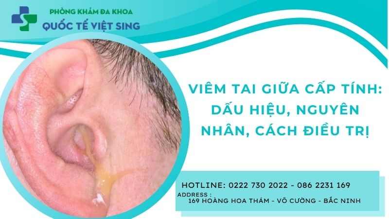 Viêm tai giữa cấp tính: Dấu hiệu, nguyên nhân, cách điều trị